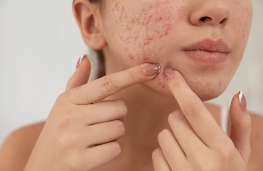 Best Treatments for Acne